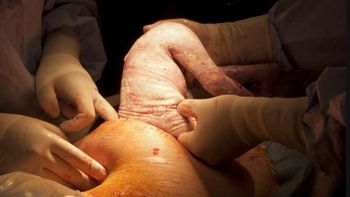 Bajar la cantidad de partos por cesáreas sin preguntar a las que ponen el cuerpo Bajar la cantidad de partos por cesáreas sin preguntar a las que ponen el cuerpo