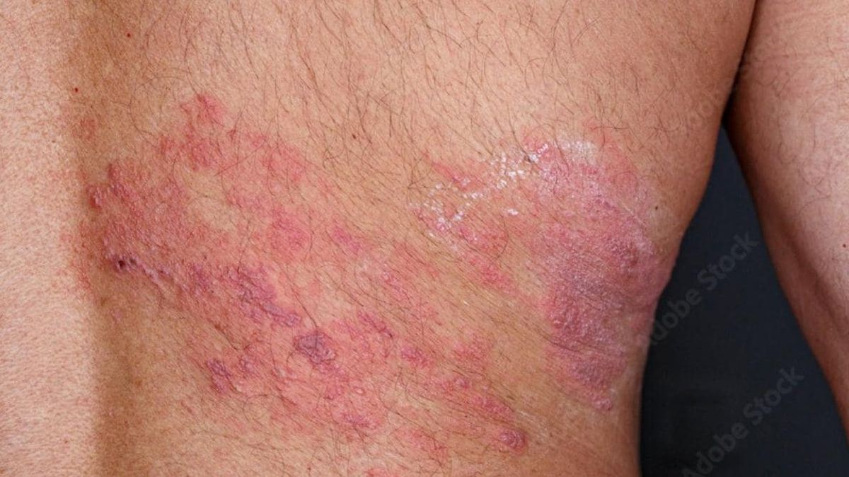 El herpes zóster provoca una dolorosa erupción en la piel con ampollas El herpes zóster provoca una dolorosa erupción en la piel con ampollas