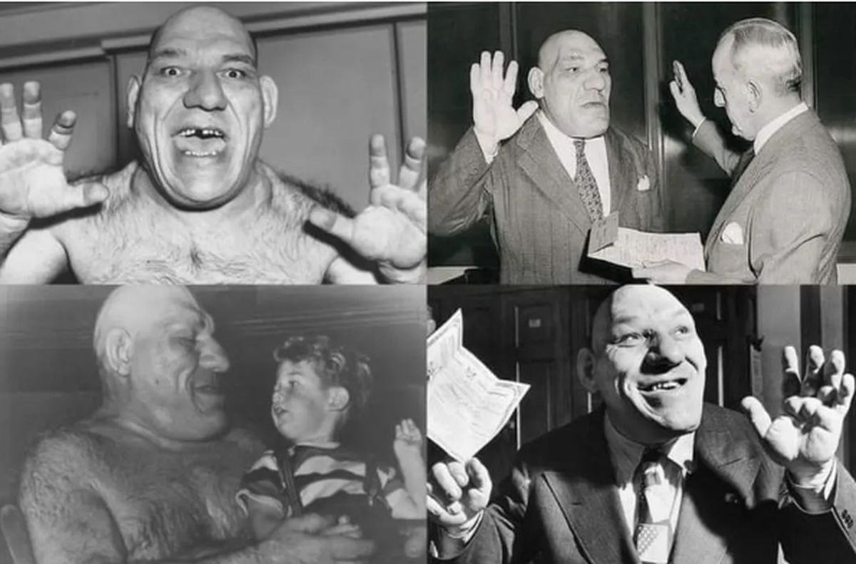 Cuando tenía 20 años, el "Shrek humano" fue diagnosticado con acromegalia (o gigantismo) Cuando tenía 20 años, el "Shrek humano" fue diagnosticado con acromegalia (o gigantismo)