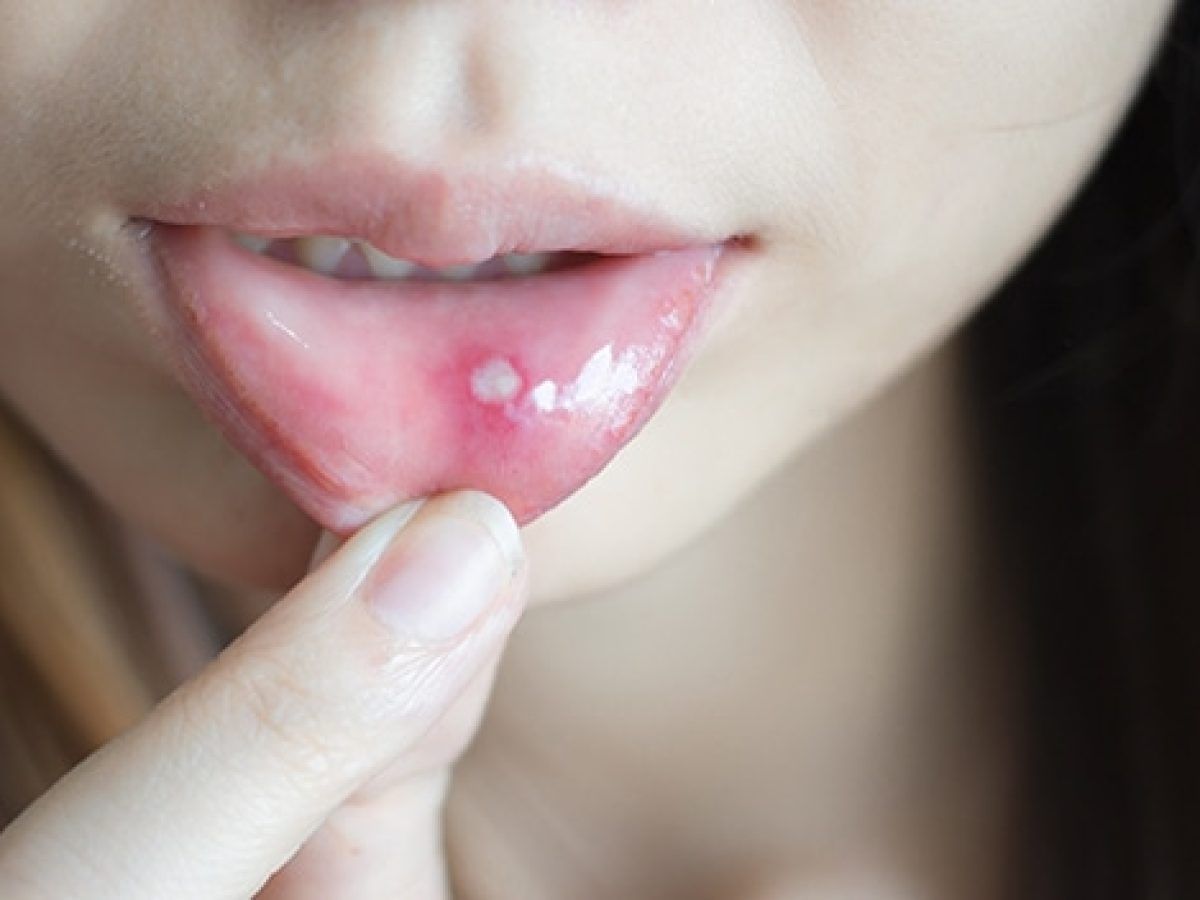 Aftas bucales: principales síntomas y causas de esta lesión según la medicina Aftas bucales: principales síntomas y causas de esta lesión según la medicina