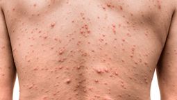Viruela del mono: la enfermedad puede ser mortal para infectados con VIH