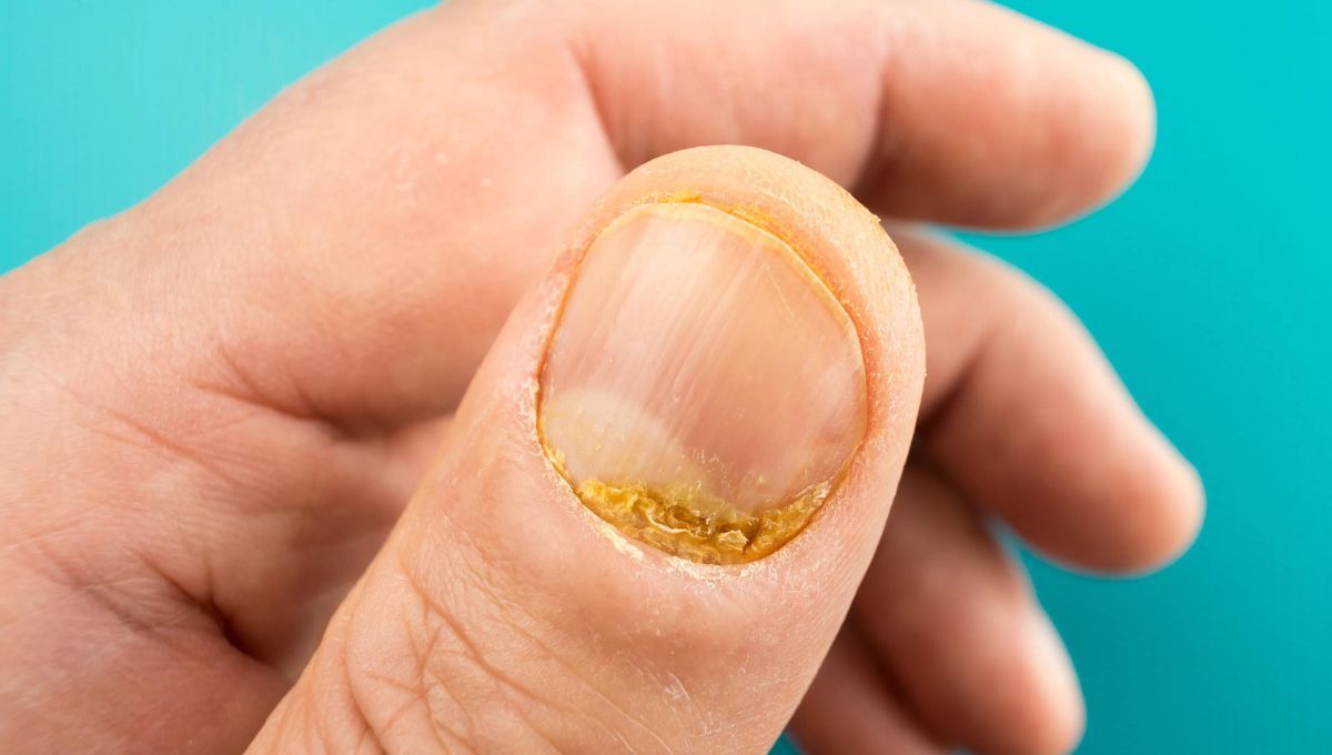 Uñas amarillas. Uñas amarillas. 