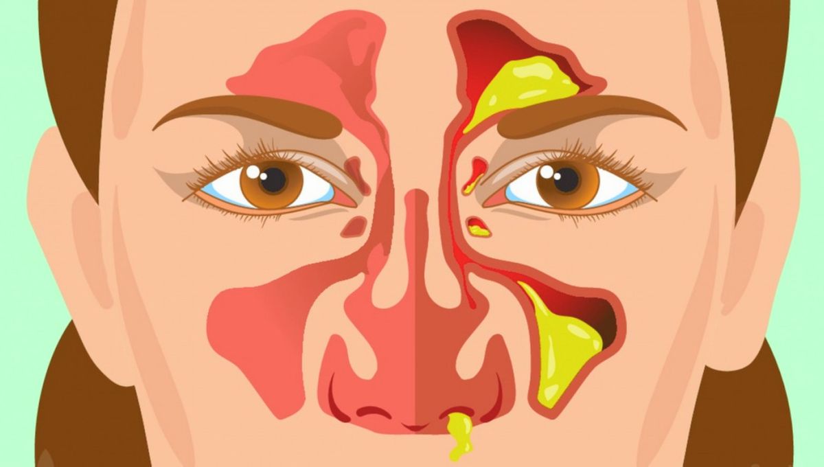 La textura y color de los mocos pueden ser un indicador de problemas de salud. La textura y color de los mocos pueden ser un indicador de problemas de salud. 