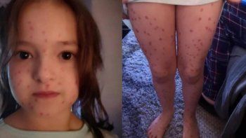 Nena simuló tener varicela para no ir a la escuela y su travesura terminó mal