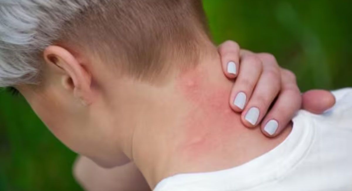 Las picaduras provocadas por el mosquito que transmite el dengue son muy visibles y son acompañadas por fiebre y dolor corporal Las picaduras provocadas por el mosquito que transmite el dengue son muy visibles y son acompañadas por fiebre y dolor corporal