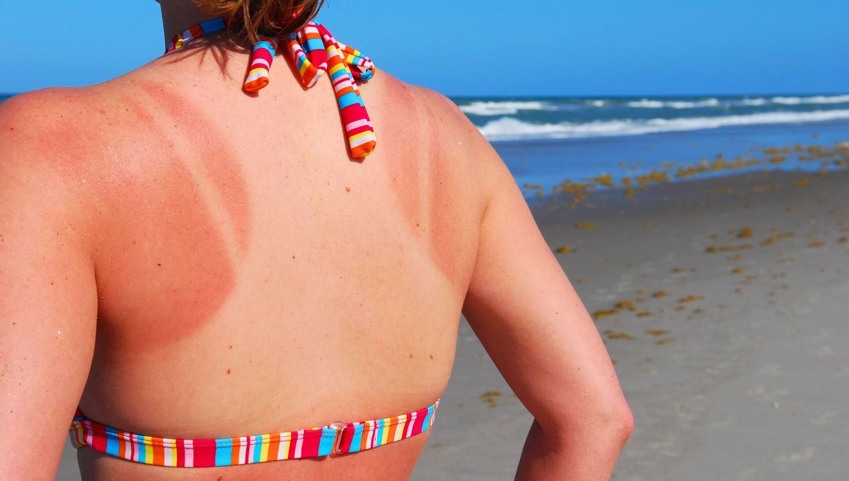 Durante los meses de m&aacute;s calor es importante proteger la piel de quemaduras.&nbsp;