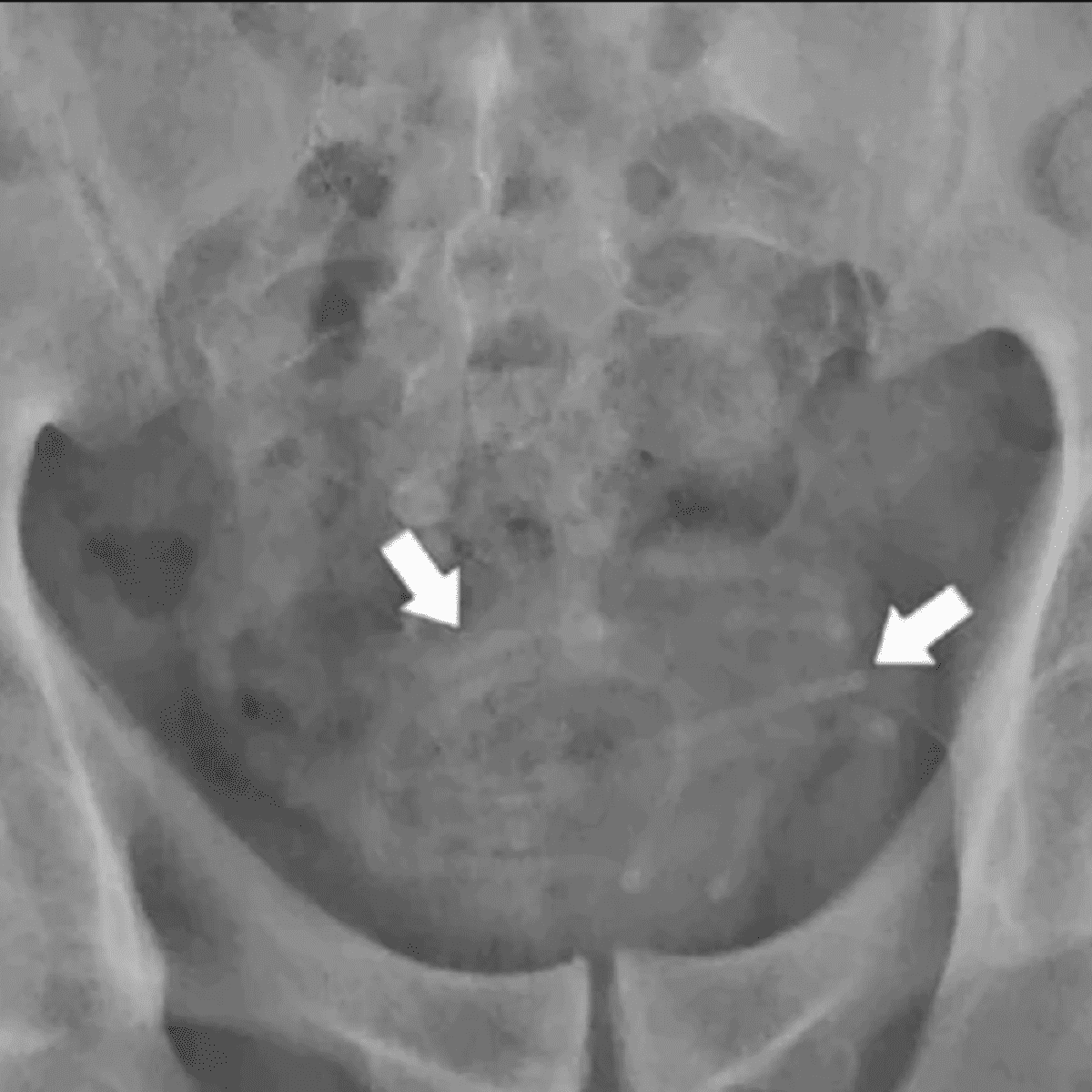 Insólito. No podía orinar y descubrieron algo increíble dentro de su vejiga.