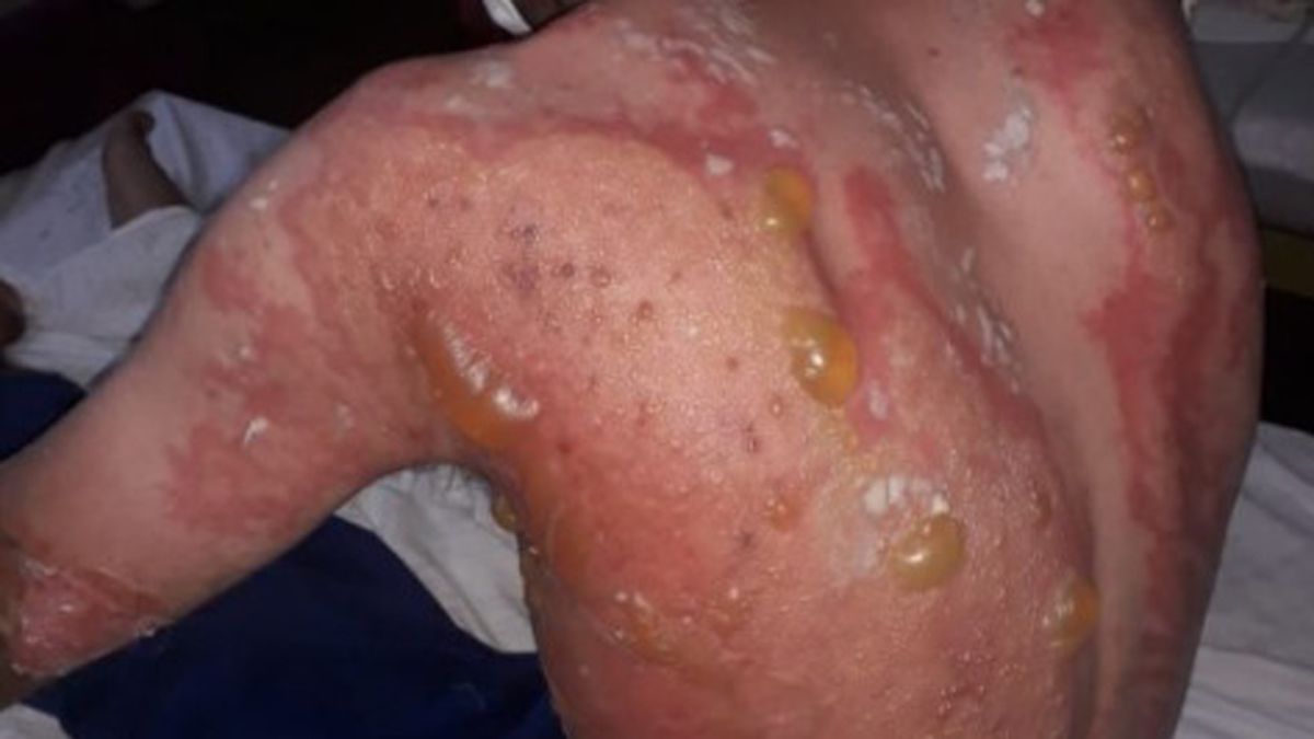 El joven había sido demorado por ebriedad y resultó quemado en la espalda cuando estaba en el calabozo. Fueron trasladados los tres policías de esa guardia, mientras investigan el caso