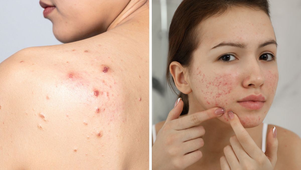 Qué están indicando los granitos en cada zona del rostro y del cuerpo