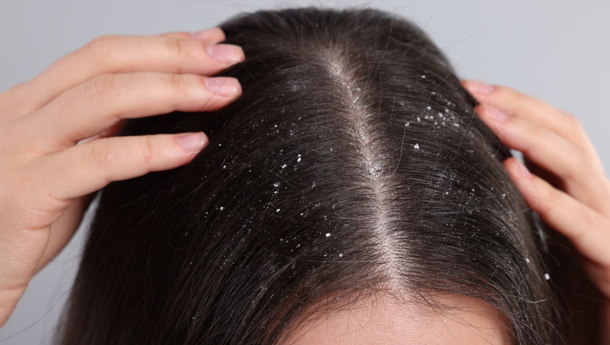 4 mezclas caseras para eliminar la caspa del cabello