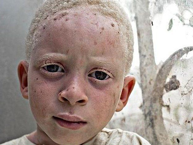 Africanos albinos, condena grabada en la piel