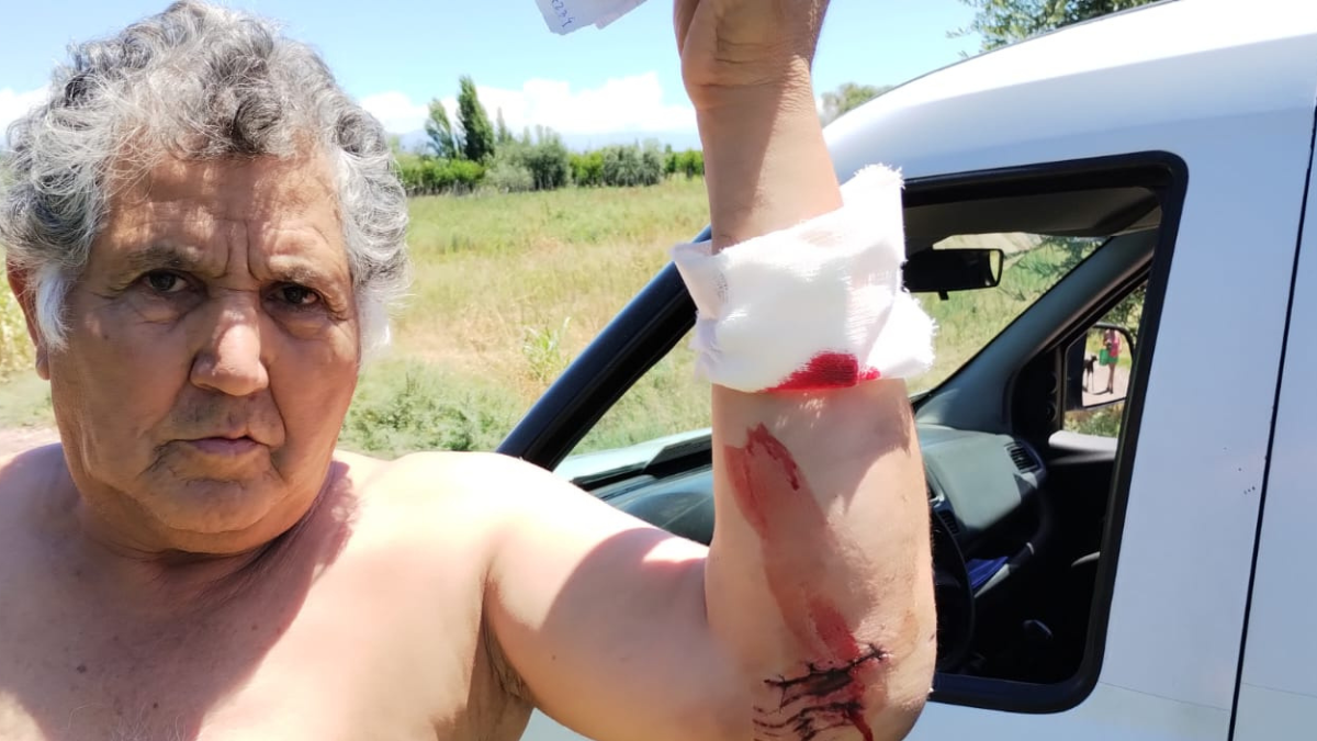 Alfredo Cardozo muestra parte de las heridas causadas por los perros.