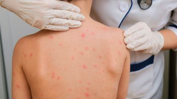 Alerta por casos de sarampión: los contagiados recorrieron 7 provincias en colectivo Alerta por casos de sarampión: los contagiados recorrieron 7 provincias en colectivo