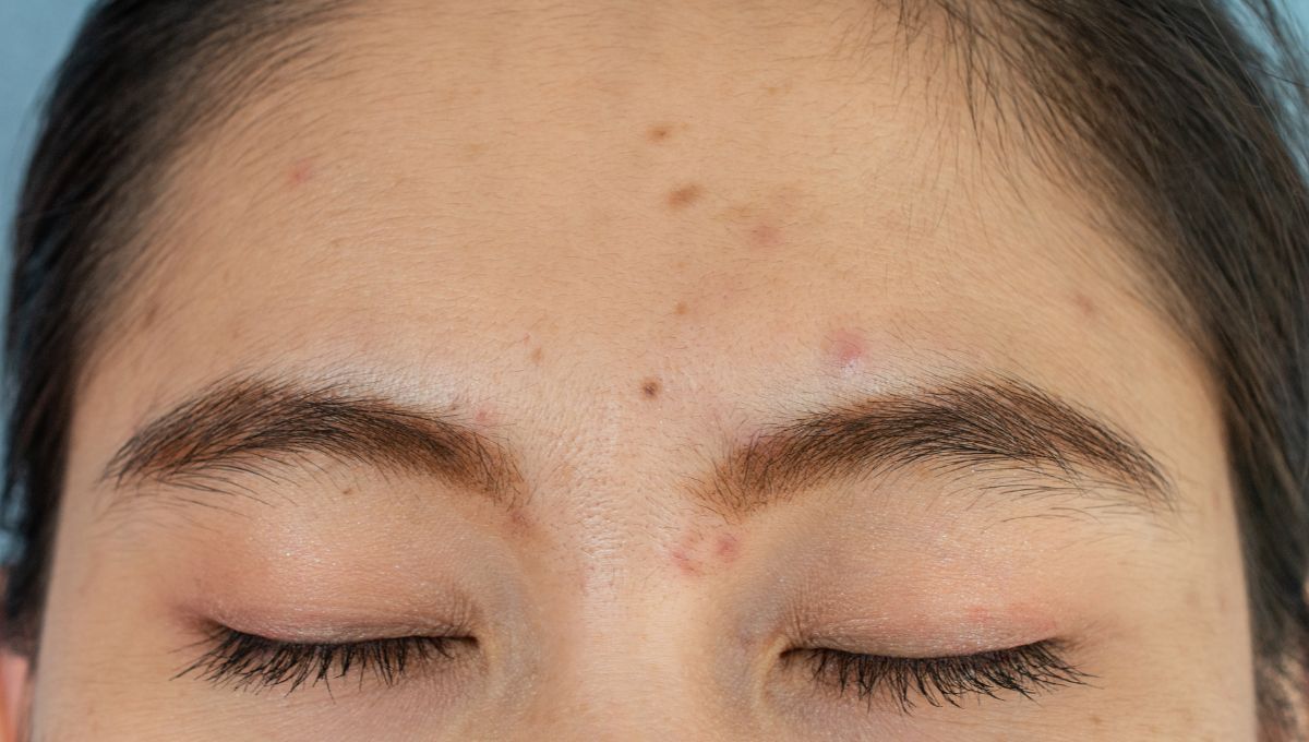 Por qué aparecen granos o acné en la zona de la frente: causas posibles