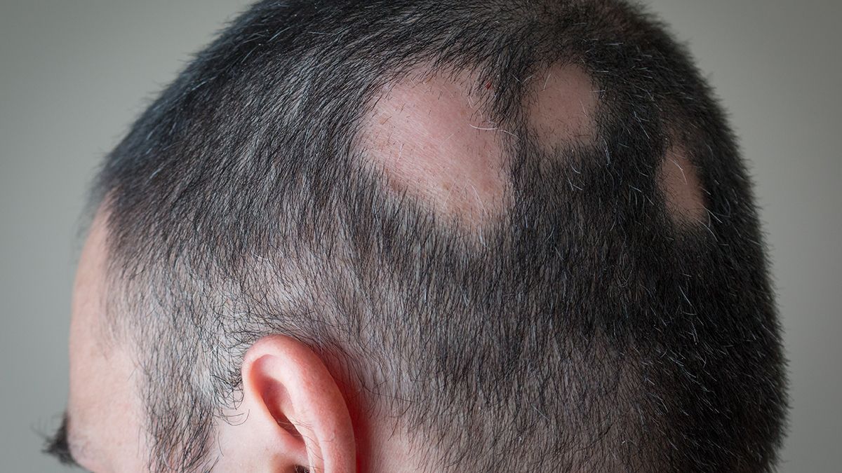 Un caso típico de alopecia areata, que puede originarse en episodios de estrés.
