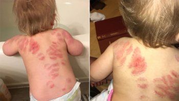 La mordieron más de 25 veces en la guardería