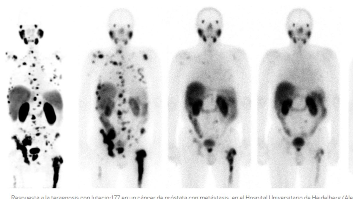 Los resultados del tratamiento experimental en pacientes con cáncer y metástasis abre una esperanza a nivel mundial.