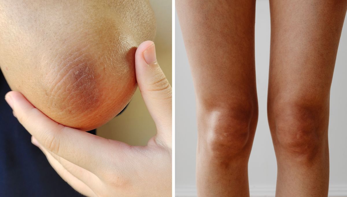 Cómo aclarar rodillas, codos y axilas negros usando solo 3 ingredientes