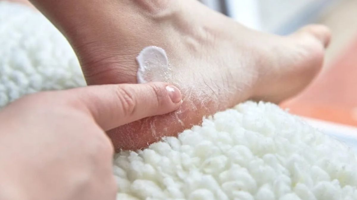 Los talones agrietados se pueden curar fácilmente con ayuda de trucos caseros.