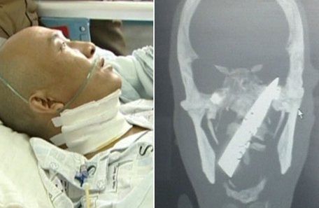 Un chino vivió cuatro años con un cuchillo en el cráneo y se lo acaban de extirpar