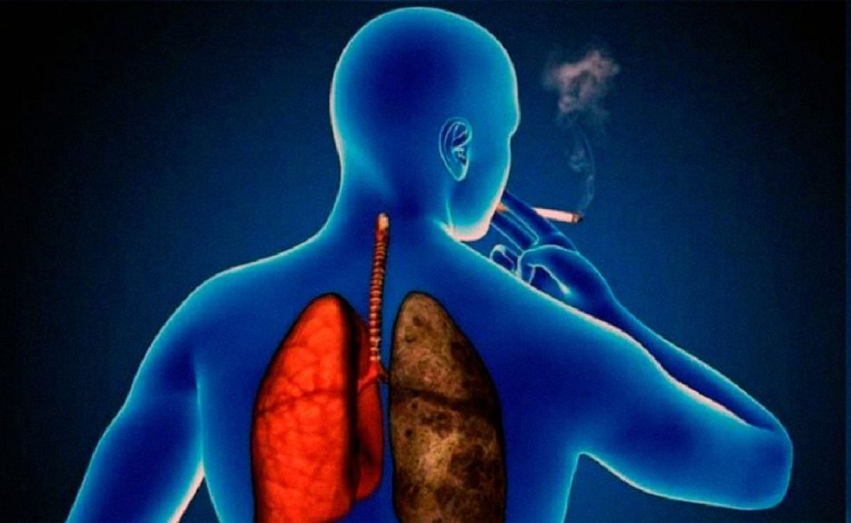 El consumo de tabaco es la principal causa de Enfermedad Pulmonar Obstructiva (EPOC),que es la tercer causa de muerte en el mundo.