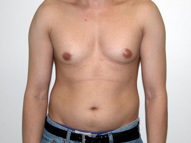 Cada vez más hombres se operan para quitarse busto