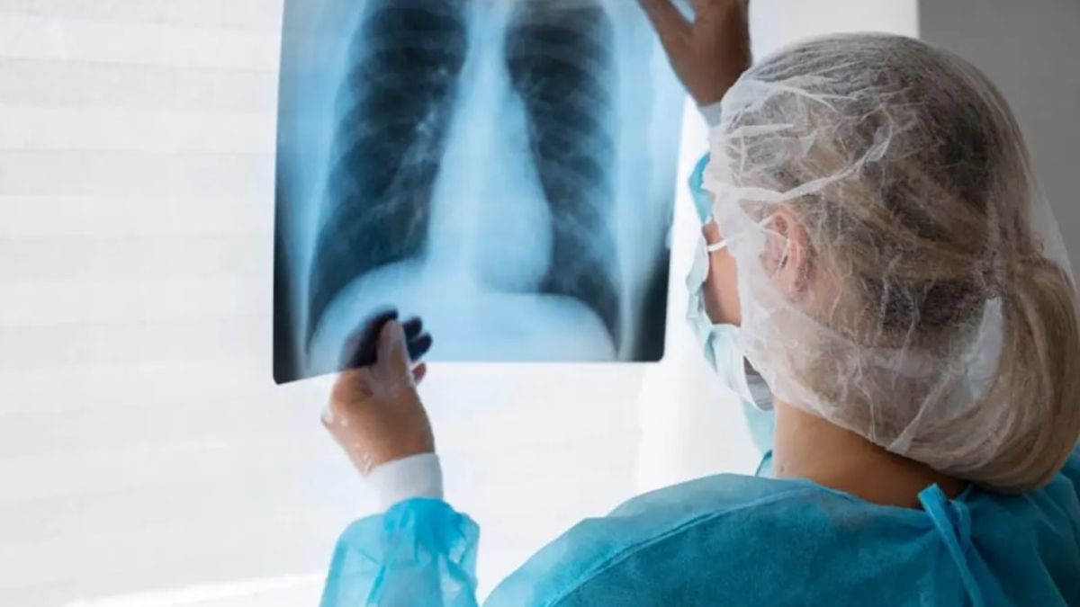 Los especialistas resaltan la necesidad de fortalecer las estrategias de prevención y detección temprana del cáncer de pulmón. Los especialistas resaltan la necesidad de fortalecer las estrategias de prevención y detección temprana del cáncer de pulmón.