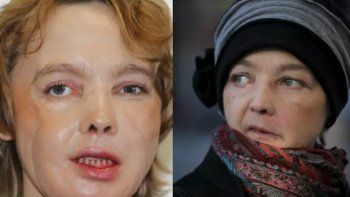 La primera trasplantada de rostro sufrió una larga agonía