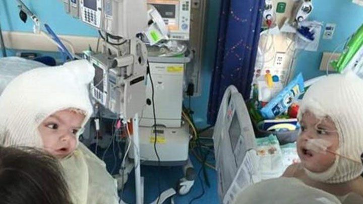 Siameses separados se ven las caras por primera vez