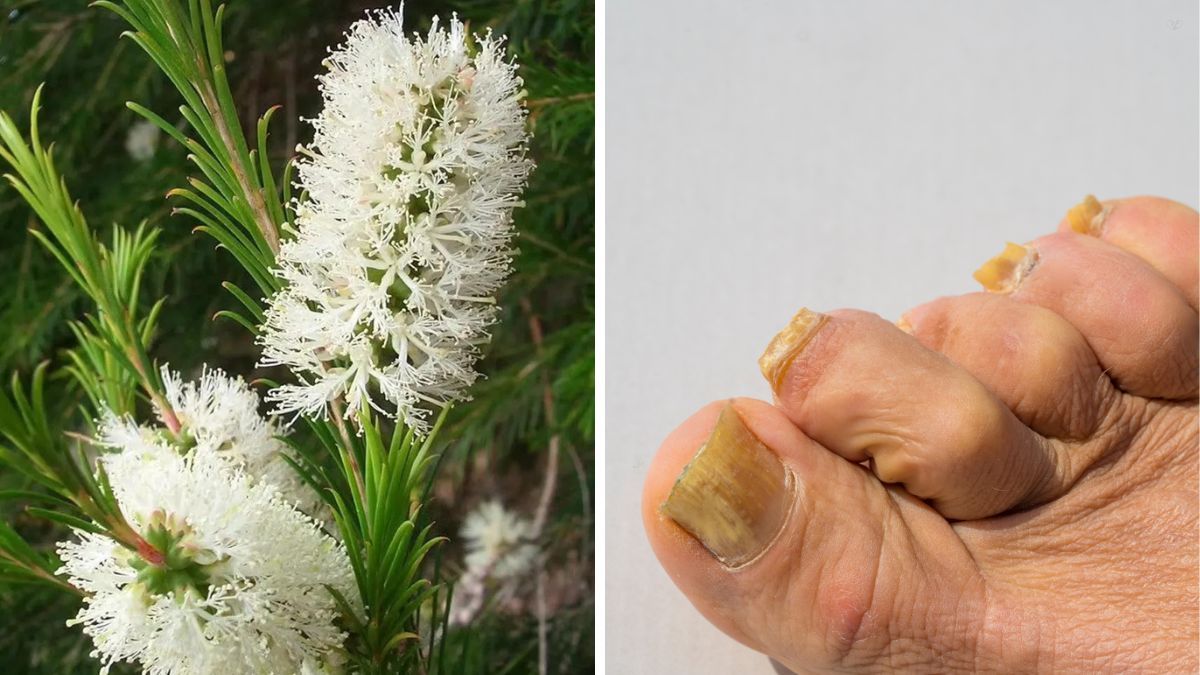 El árbol de té puede ayudar a eliminar los hongos de las uñas. El árbol de té puede ayudar a eliminar los hongos de las uñas.