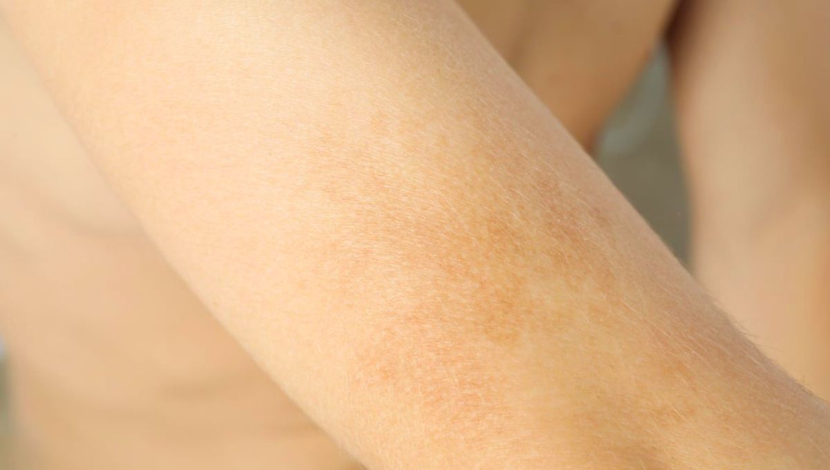 Todos tenemos manchas de nacimiento en diversas partes del cuerpo, incluso los animales. Todos tenemos manchas de nacimiento en diversas partes del cuerpo, incluso los animales.