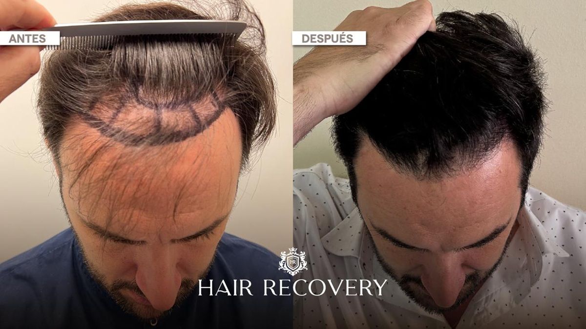 El antes y el después de un microtrasplante capilar pelo por pelo, con resultados sumamente naturales. El antes y el después de un microtrasplante capilar pelo por pelo, con resultados sumamente naturales.