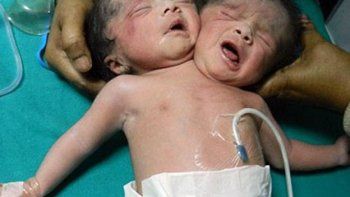 Murieron las siamesas que nacieron con dos cabezas y un solo cuerpo en Bangladesh