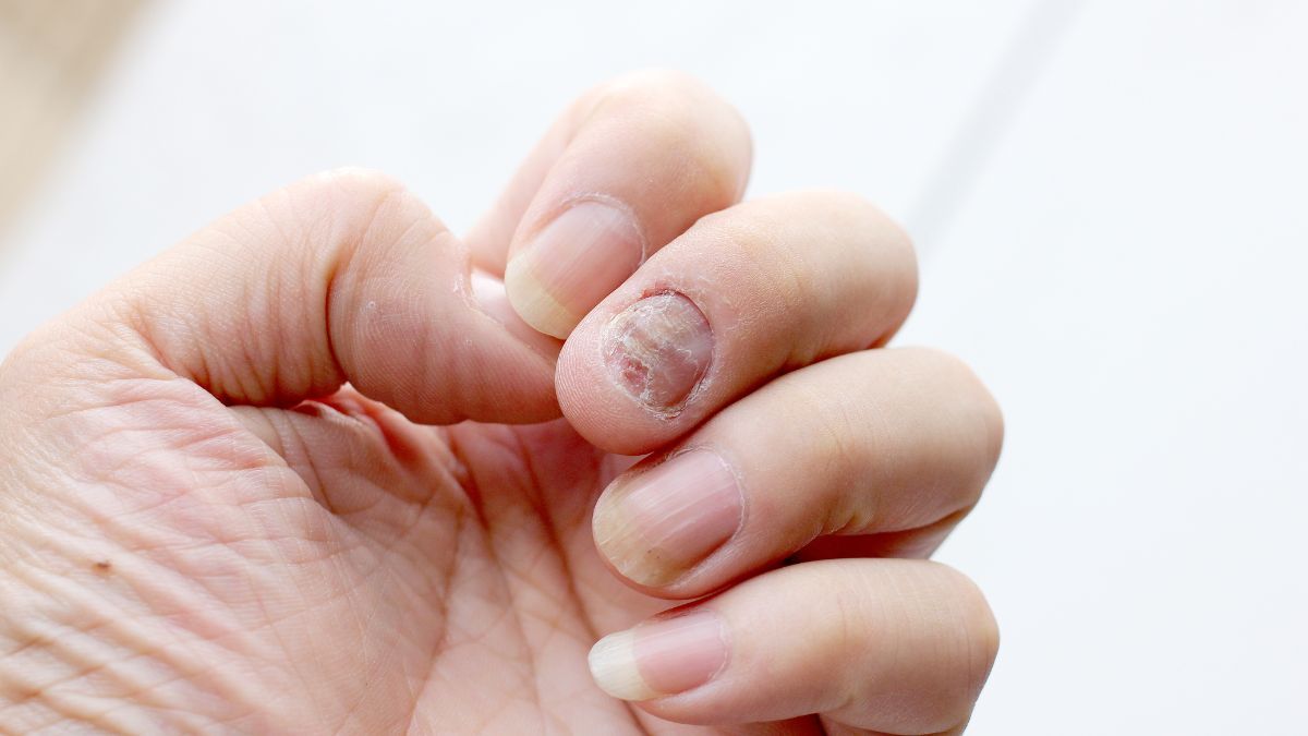 Uñas con hongos. Uñas con hongos.