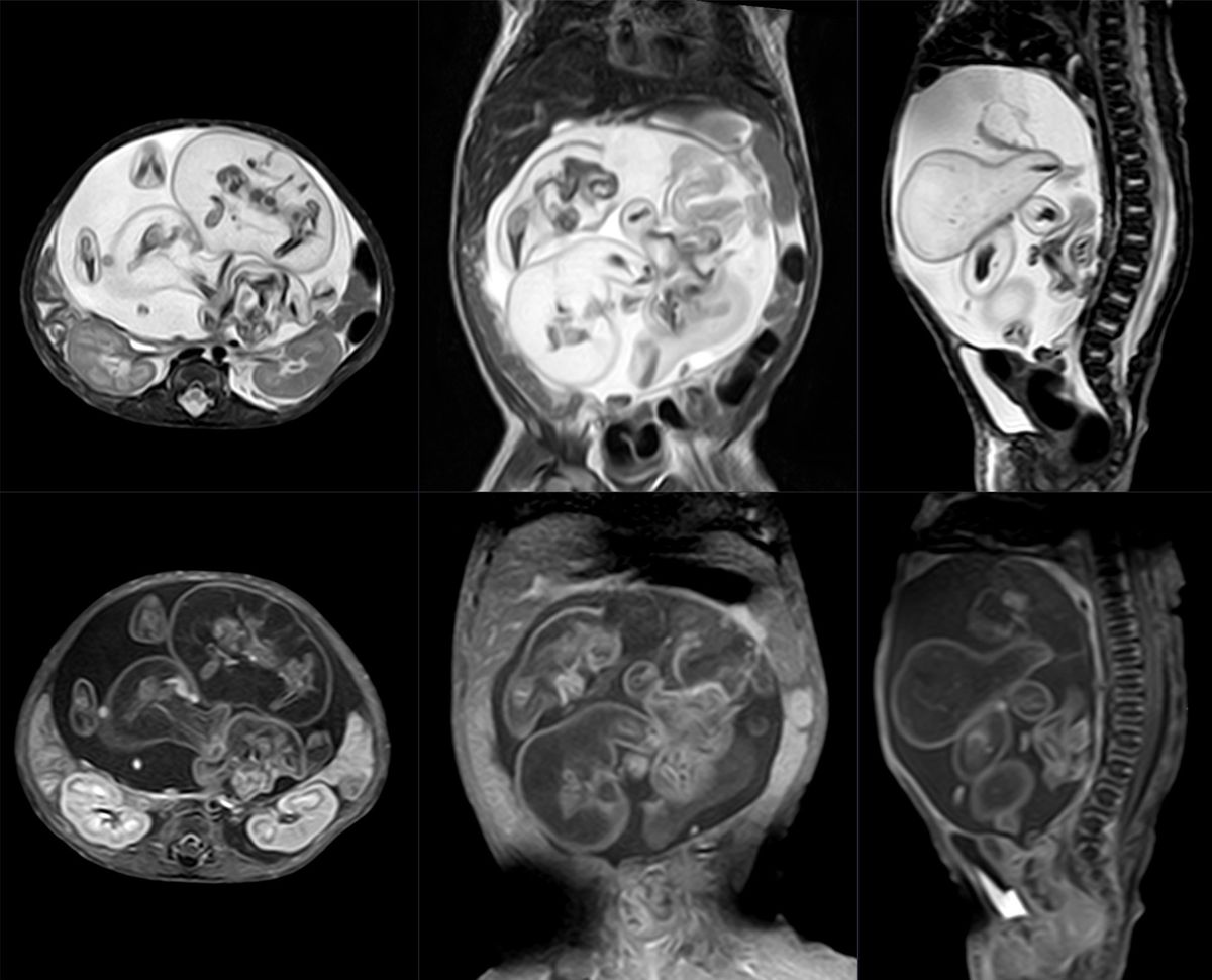 Fetus in Fetu: la extraña condición donde un gemelo crece adentro de otro. Fetus in Fetu: la extraña condición donde un gemelo crece adentro de otro. 