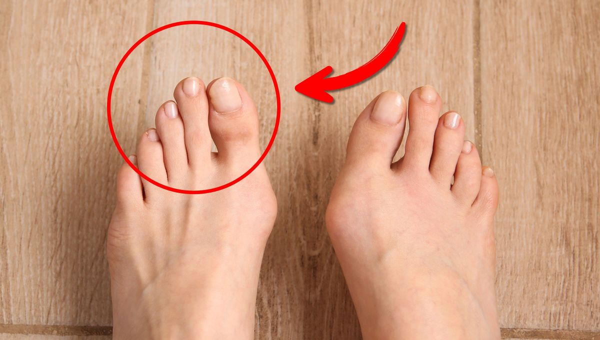 ¿Qué significa tener el segundo dedo del pie más largo que el resto?