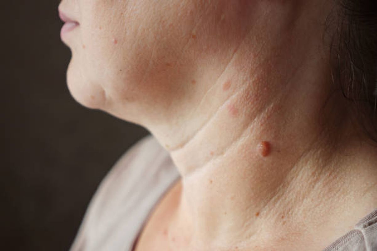 Las verrugas aparecen en distintos sectores del cuerpo. Las verrugas aparecen en distintos sectores del cuerpo.
