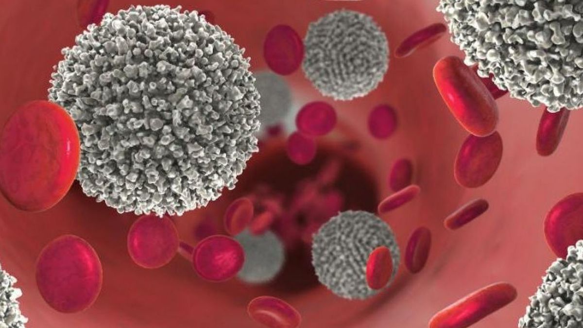 Avances que la ciencia viene desarrollando han mejorado el tratamiento contra la leucemia meloide crónica, la más frecuente en adultos Avances que la ciencia viene desarrollando han mejorado el tratamiento contra la leucemia meloide crónica, la más frecuente en adultos