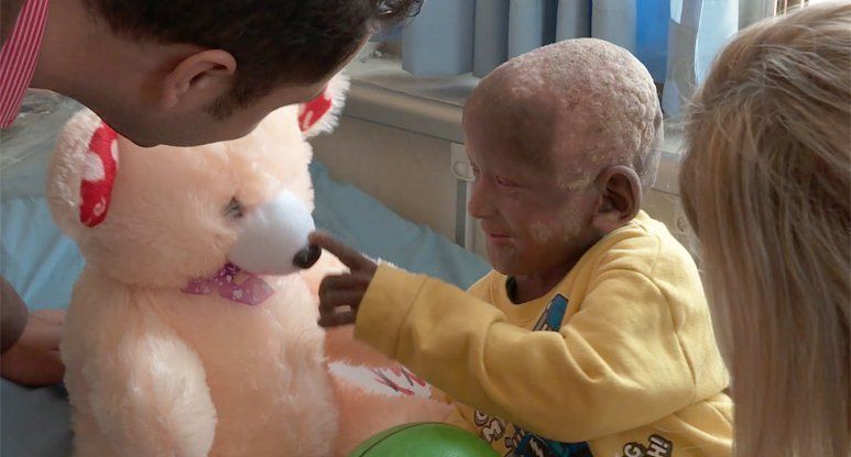 Qué es Ictiosis Arlequín, el padecimiento del niño nepalí que se convierte en piedra