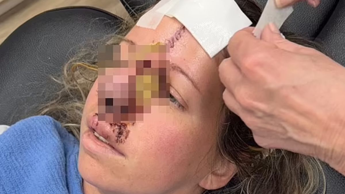 Su perro le arrancó la nariz cuando la mujer le quiso dar un beso. Su perro le arrancó la nariz cuando la mujer le quiso dar un beso.