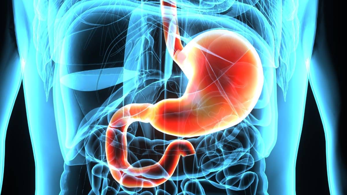 Los síntomas de cáncer de estómago que aparecen después de comer. Los síntomas de cáncer de estómago que aparecen después de comer.