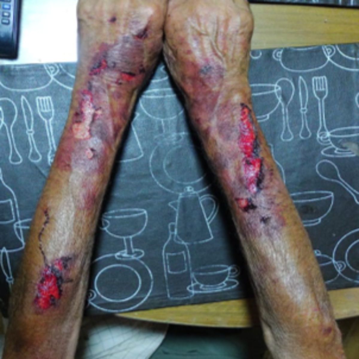 Evidencia de las lesiones que le infringieron a uno de los ancianos torturados para robarles.