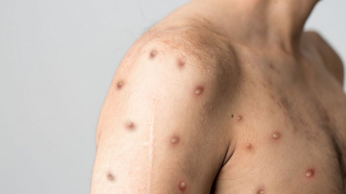 Los síntomas de viruela del mono se pueden manifestar por dolor de cabeza, fiebre, cansancio y erupciones en el cuerpo Los síntomas de viruela del mono se pueden manifestar por dolor de cabeza, fiebre, cansancio y erupciones en el cuerpo