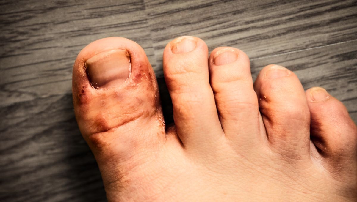 Los hongos de los pies pueden ser transmitidos fácilmente