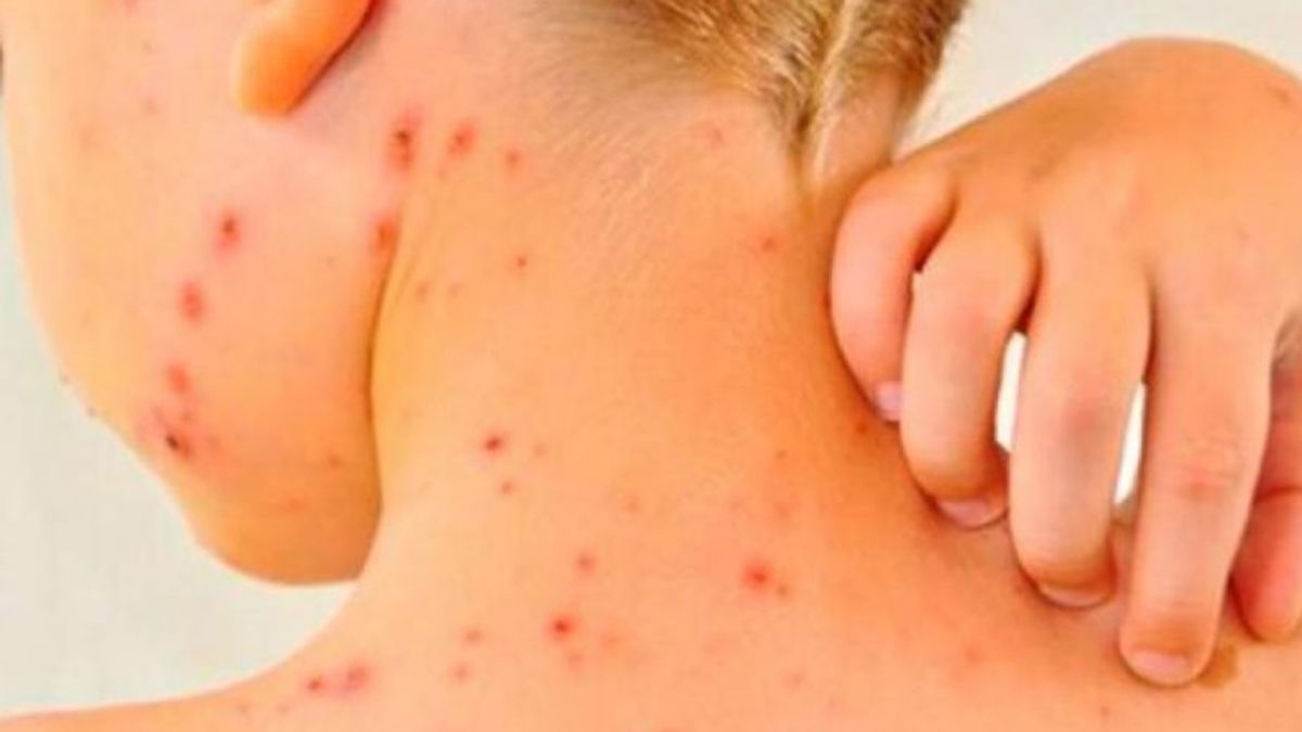 Sarampión: alerta por un brote de la enfermedad en diez países de América