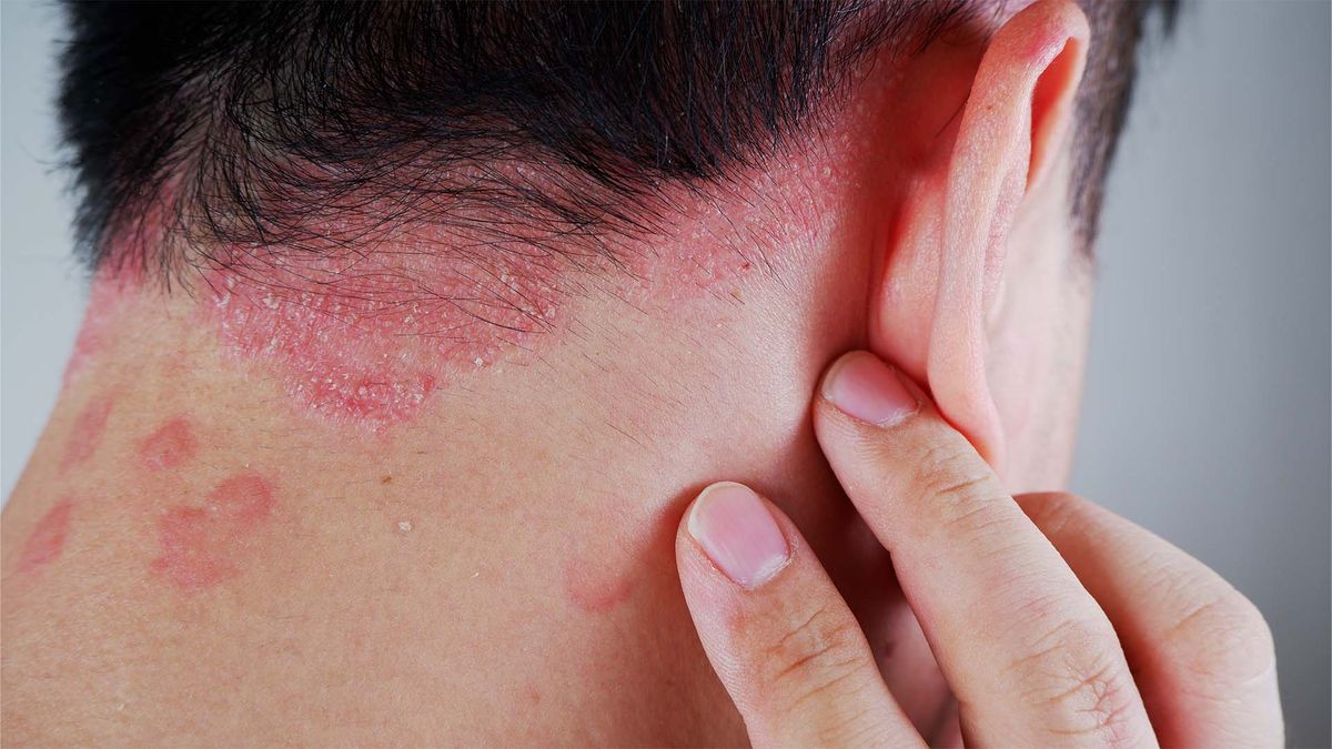 Psoriasis. Psoriasis. 