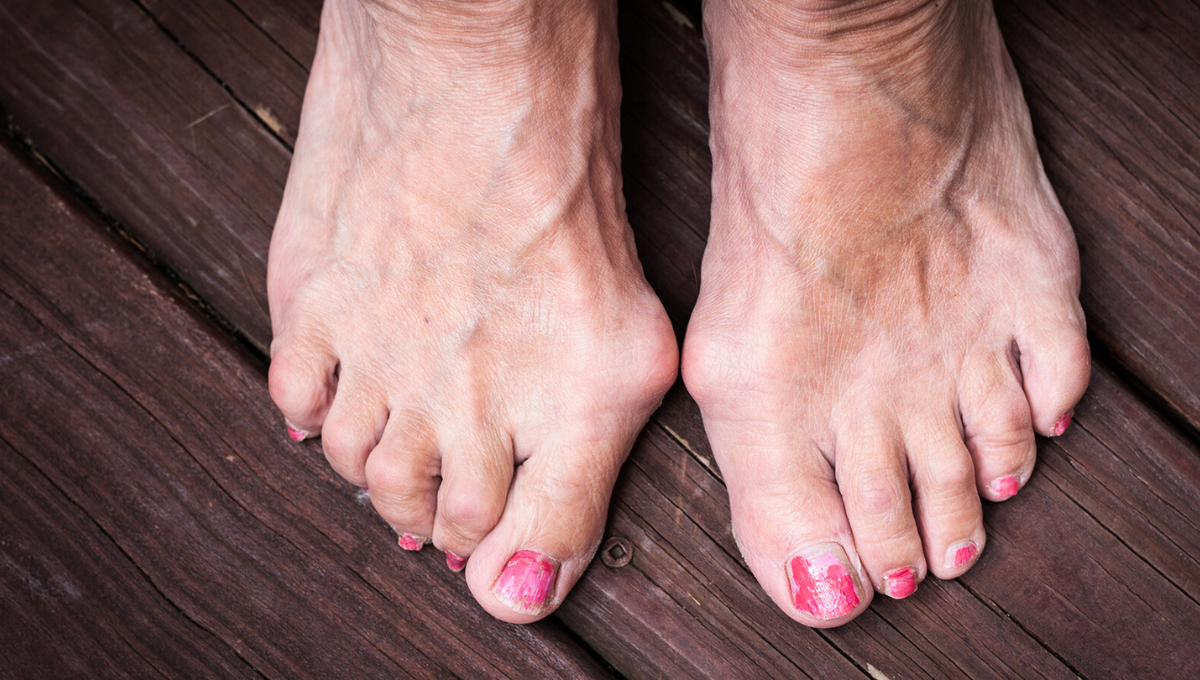 Los juanetes pueden ser prevenidos y eliminados con una serie de métodos