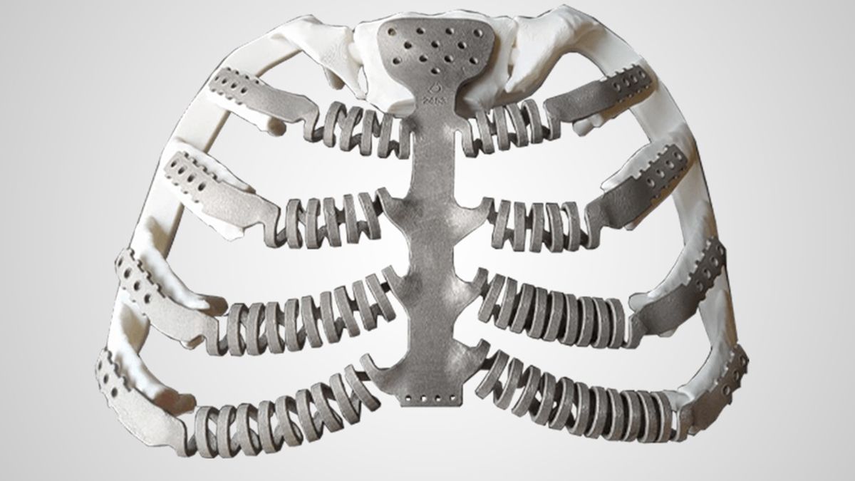 Reconstrucción torácica con prótesis 3D a medida.