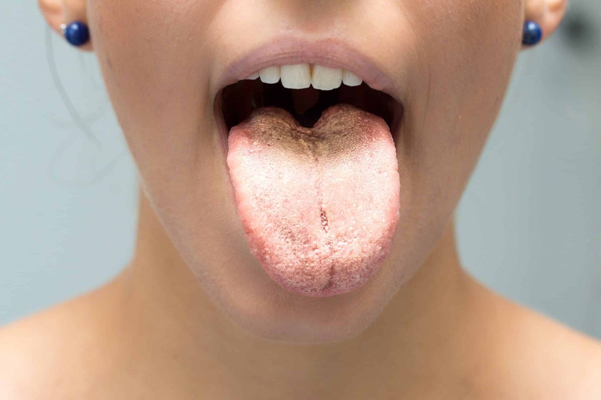 Lengua blanca. Lengua blanca.