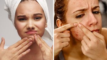 Descubre por qué te salen granos en diversas partes del rostro Descubre por qué te salen granos en diversas partes del rostro